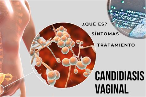 manchas hongos en los senos|Síntomas y tratamiento de la candidiasis mamaria